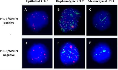 PRL-3 and MMP9 Expression and Epithelial-Mesenchymal Transition Markers in Circulating Tumor Cells From Patients With Colorectal Cancer: Potential Value in Clinical Practice